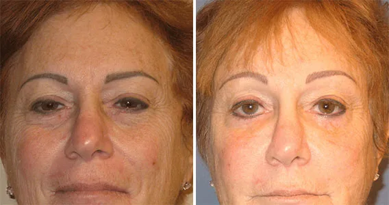 Brow lift Scottsdale, AZ - Before & After Results