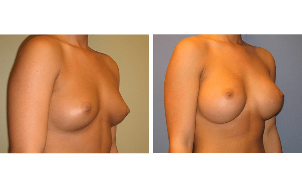 Breast Augmentation - Case 11 (2)