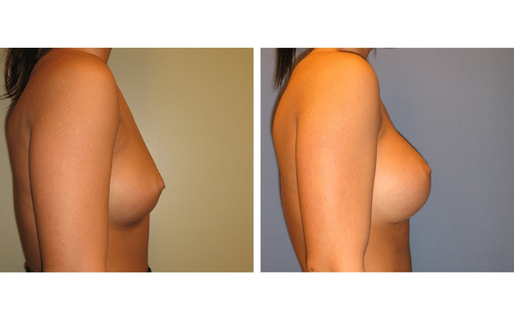 Breast Augmentation - Case 11 (3)
