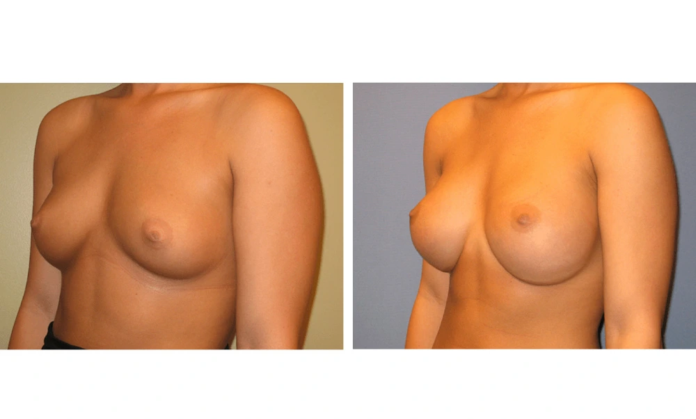 Breast Augmentation - Case 11 (4)