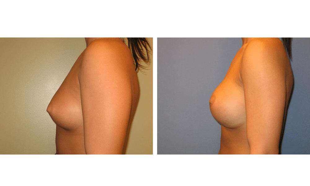 Breast Augmentation - Case 11 (5)