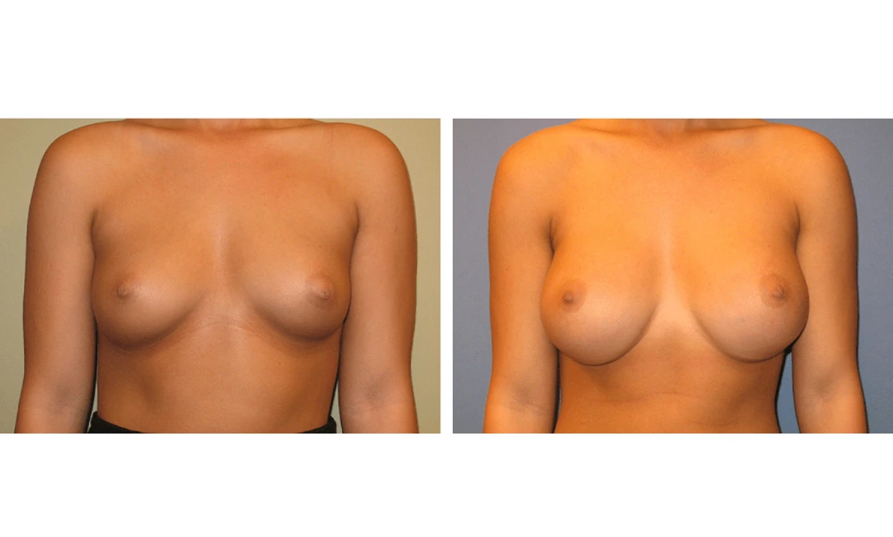 Breast Augmentation - Case 11
