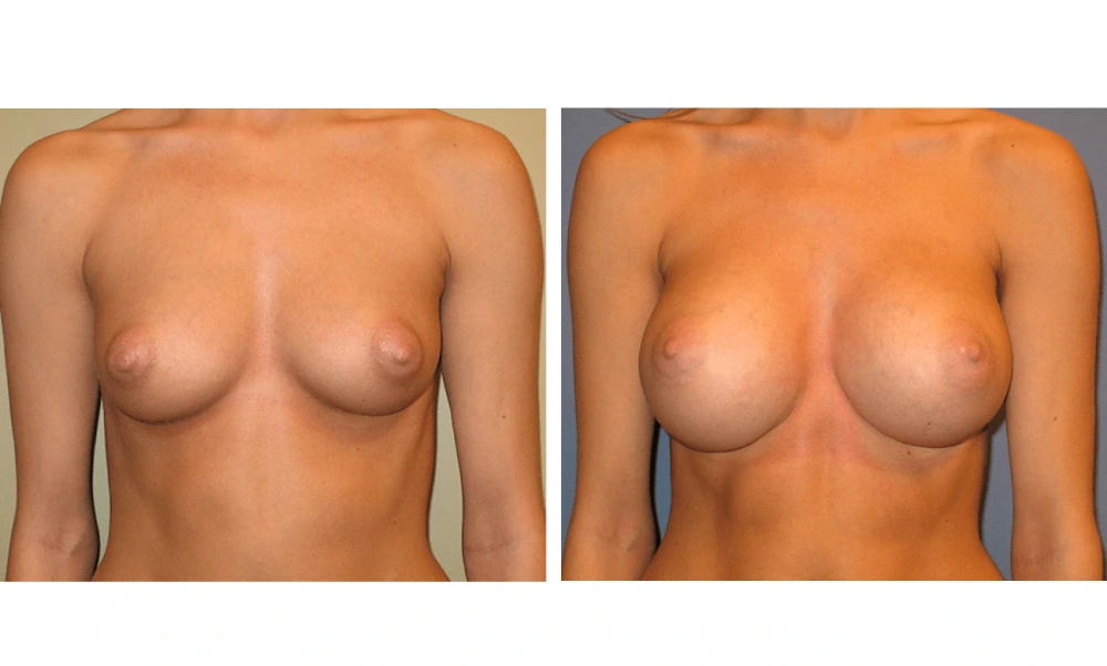 Breast Augmentation - Case 12
