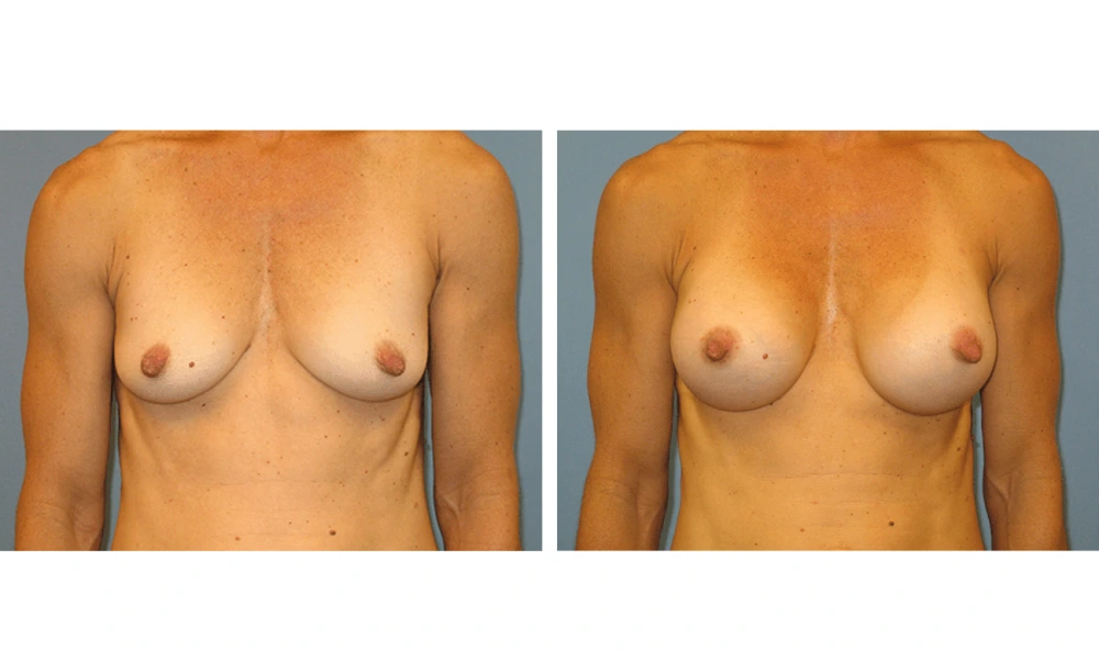 Breast Augmentation - Case 13