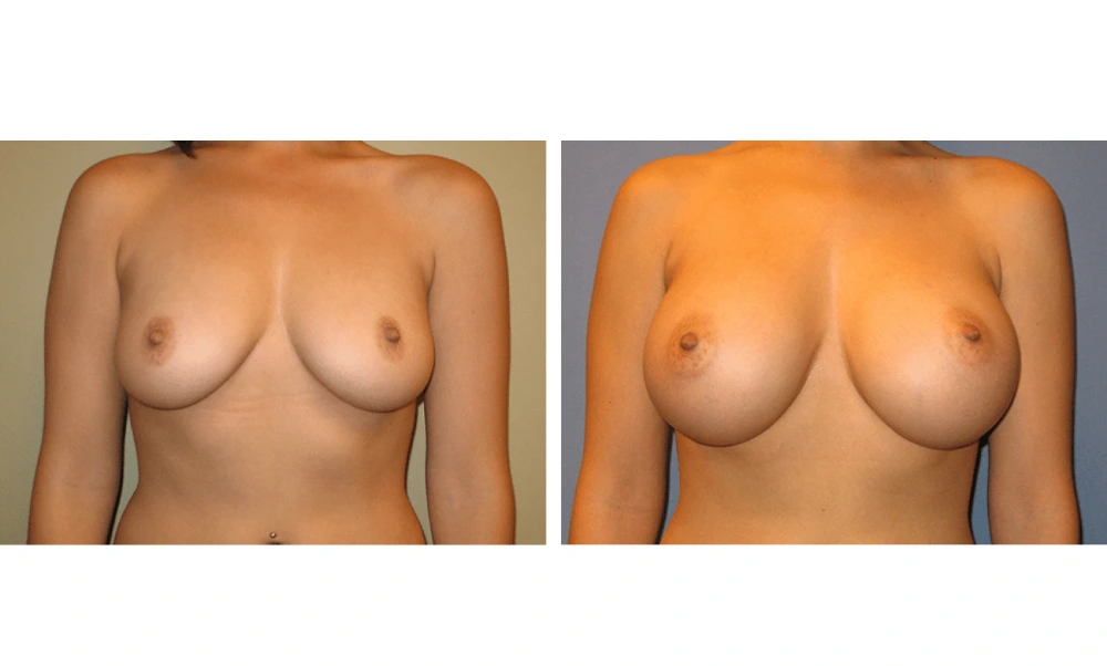 Breast Augmentation - Case 15