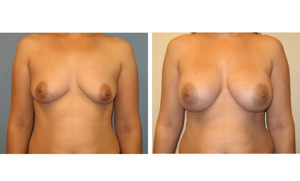 Breast Augmentation - Case 16