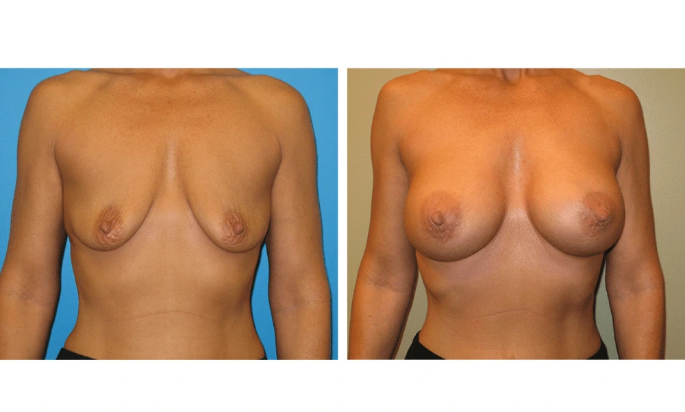 Breast Augmentation - Case 17