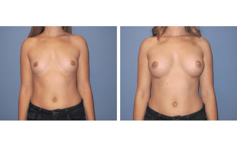 Breast Augmentation - Case 18