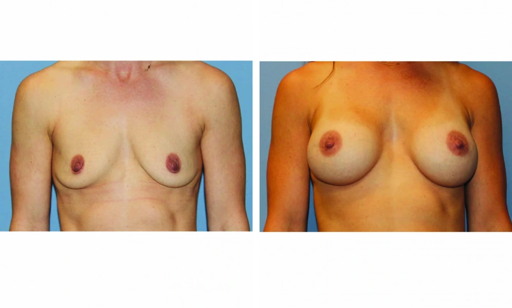 Breast Augmentation - Case 19
