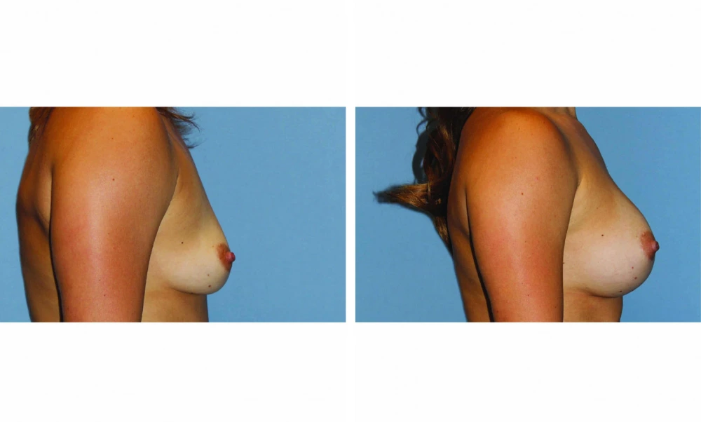 Breast Augmentation - Case 20 (3)