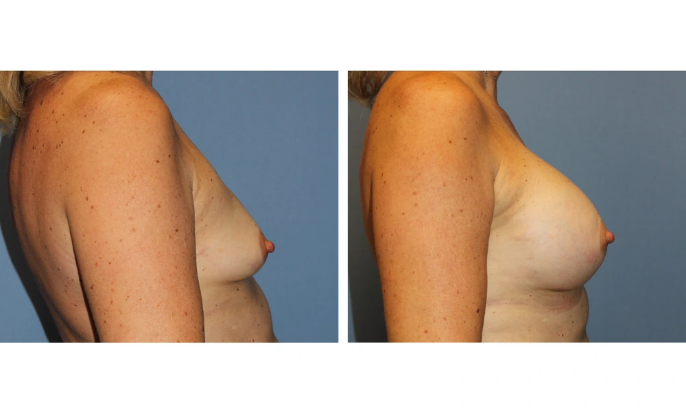 Breast Augmentation - Case 21 (3)
