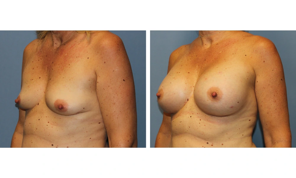 Breast Augmentation - Case 21 (4)