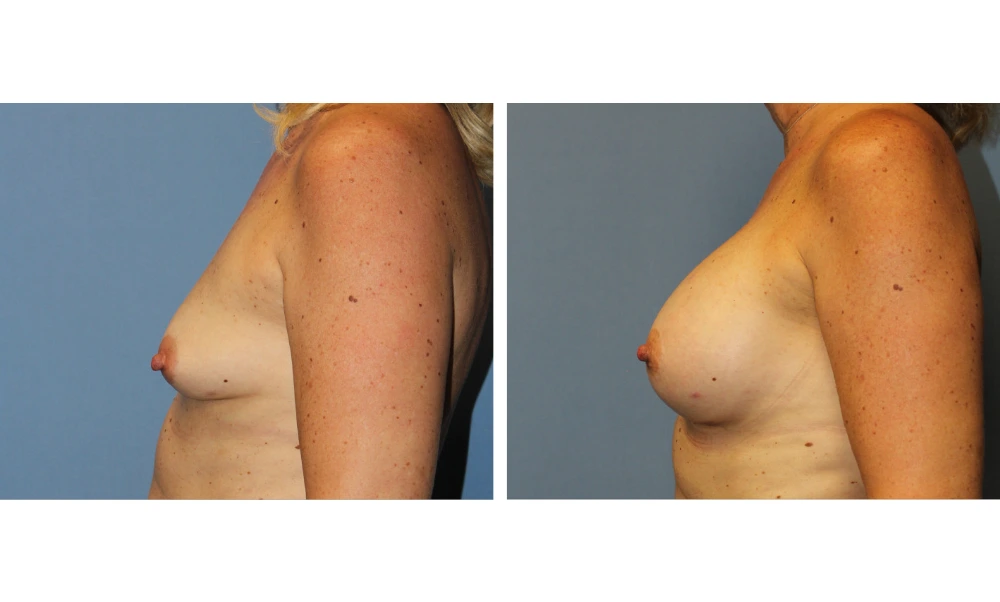 Breast Augmentation - Case 21 (5)