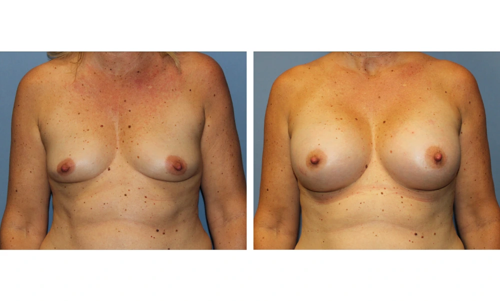 Breast Augmentation - Case 21