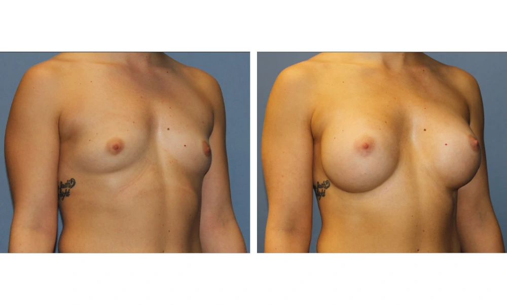 Breast Augmentation - Case 22 (2)