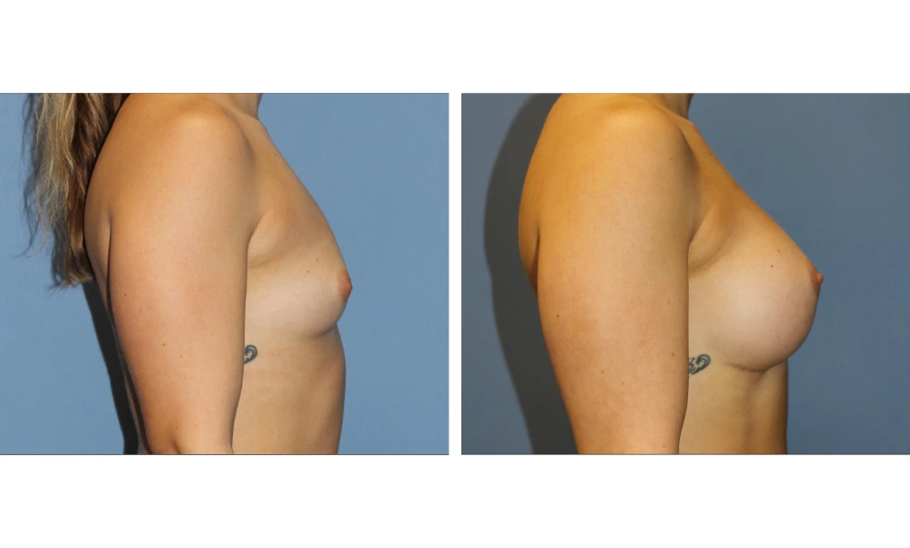 Breast Augmentation - Case 22 (3)