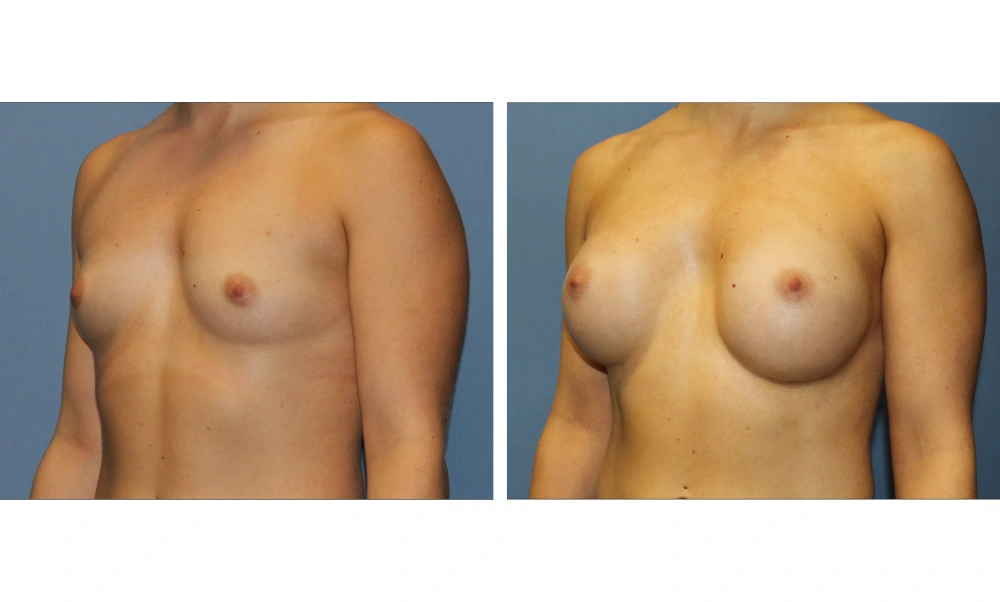 Breast Augmentation - Case 22 (4)