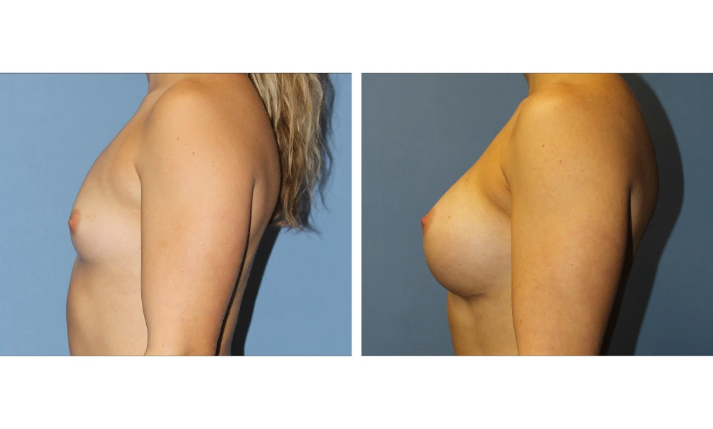 Breast Augmentation - Case 22 (5)