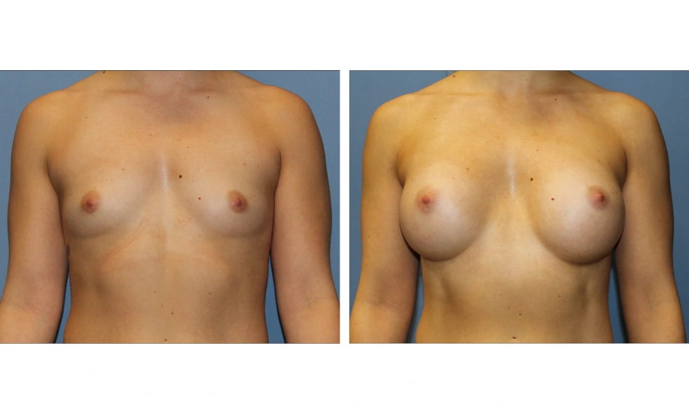 Breast Augmentation - Case 22