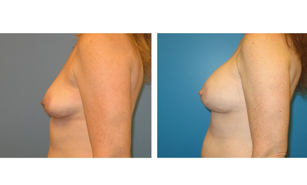 Breast Augmentation - Case 3 (5)