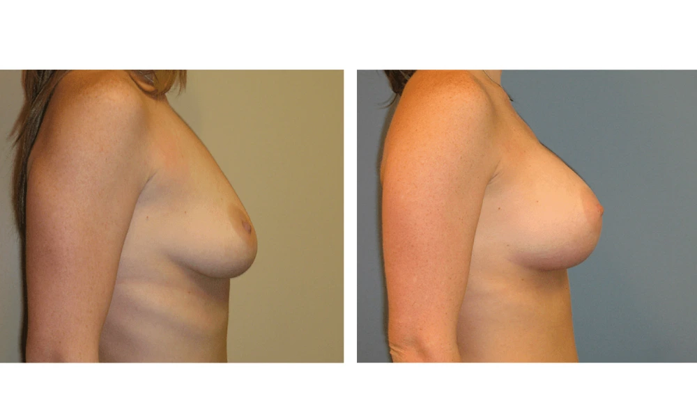 Breast Augmentation - Case 4 (3)