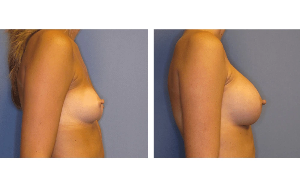 Breast Augmentation - Case 6 (3)