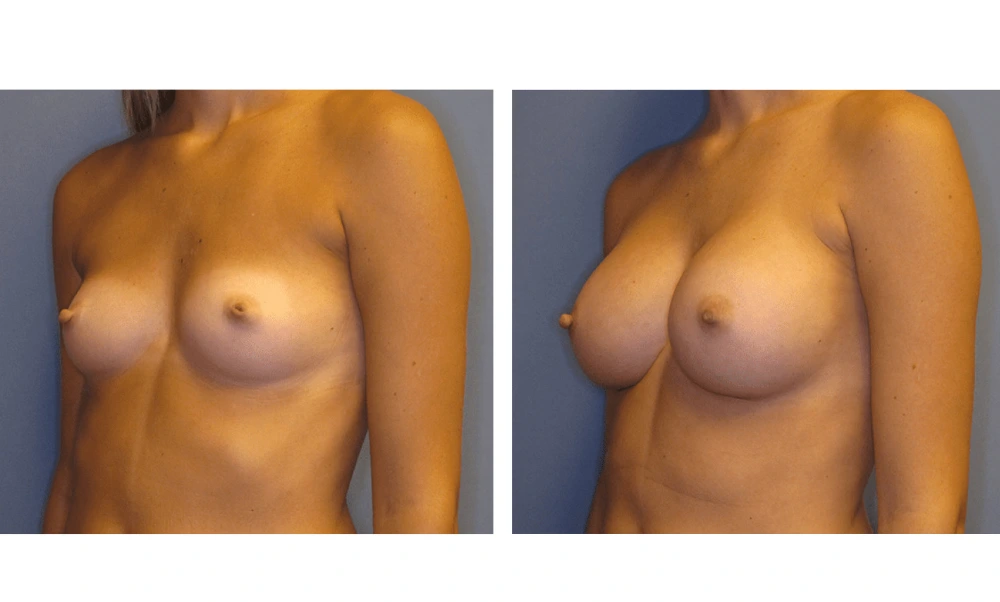 Breast Augmentation - Case 6 (4)