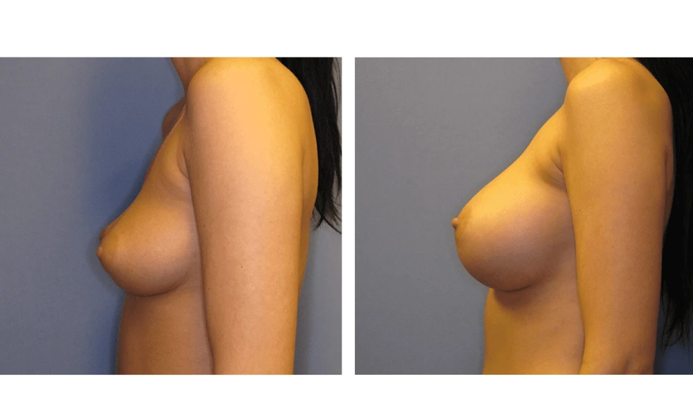 Breast Augmentation - Case 7 (5)