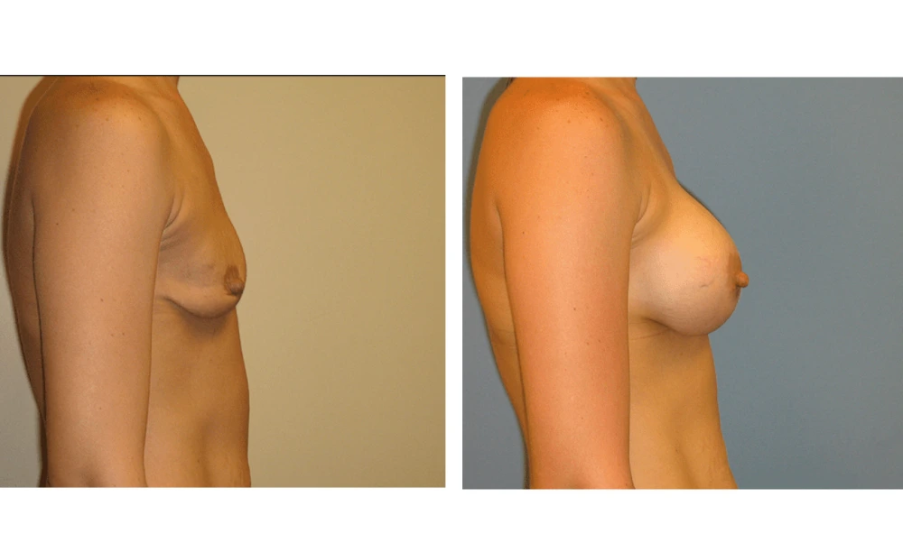 Breast Augmentation - Case 8 (3)