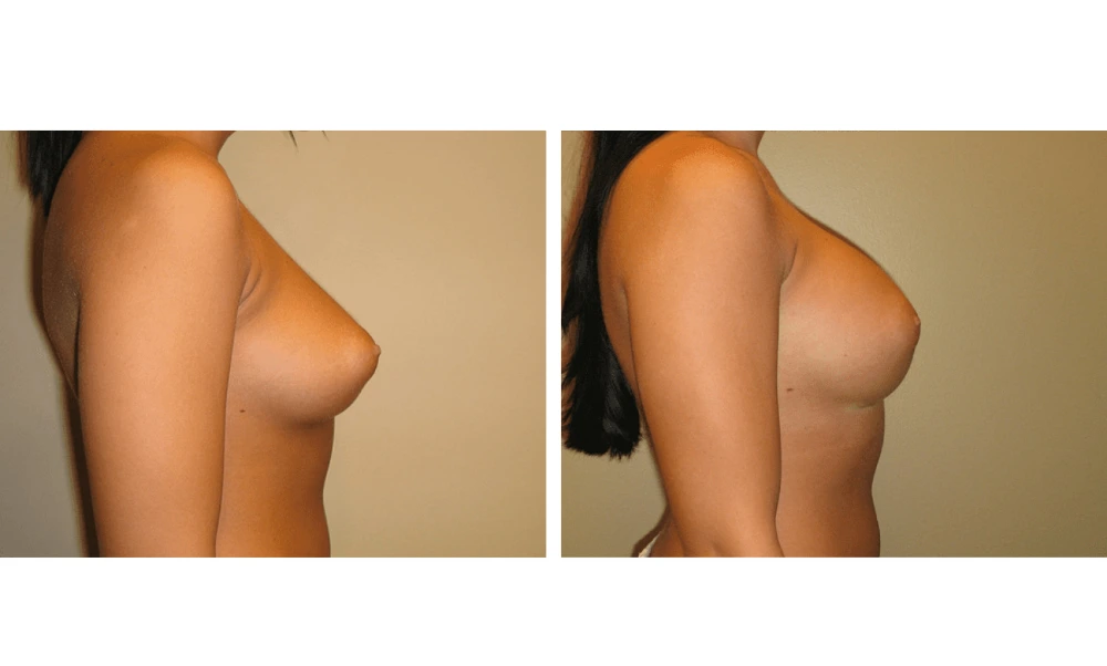 Breast Augmentation - Case 9 (3)