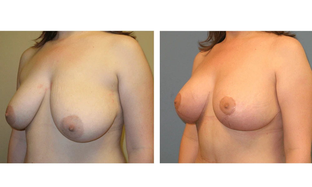 Breast Lift (Mastopexy) - Case 2 (3)