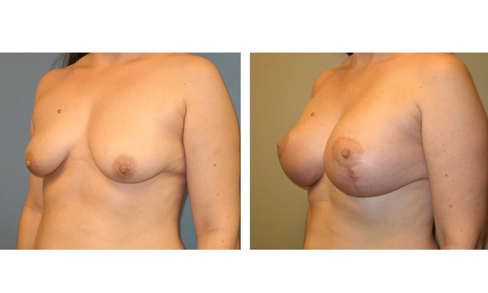 Breast Lift (Mastopexy) - Case 3 (3)