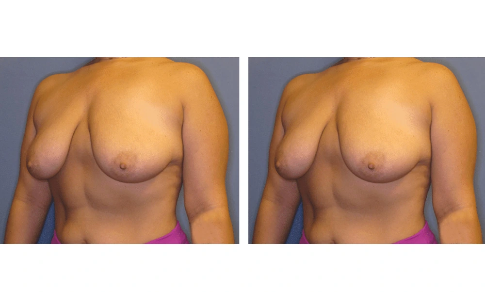 Breast Lift (Mastopexy) - Case 4 (3)
