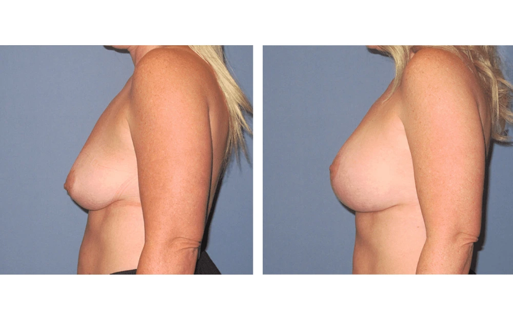 Breast Lift (Mastopexy) - Case 6 (4)