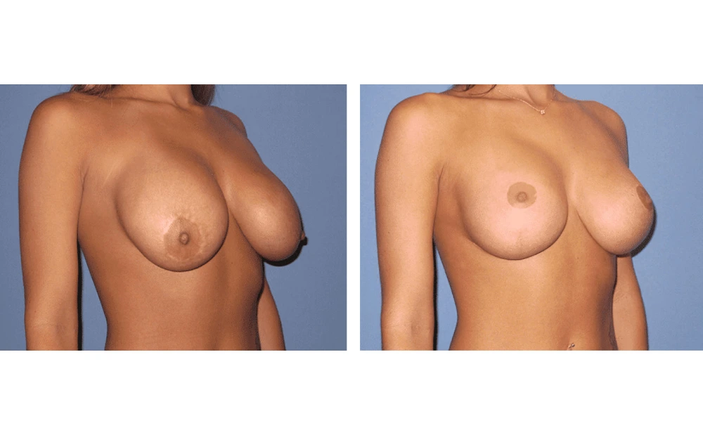 Breast Lift (Mastopexy) - Case 7 (1)