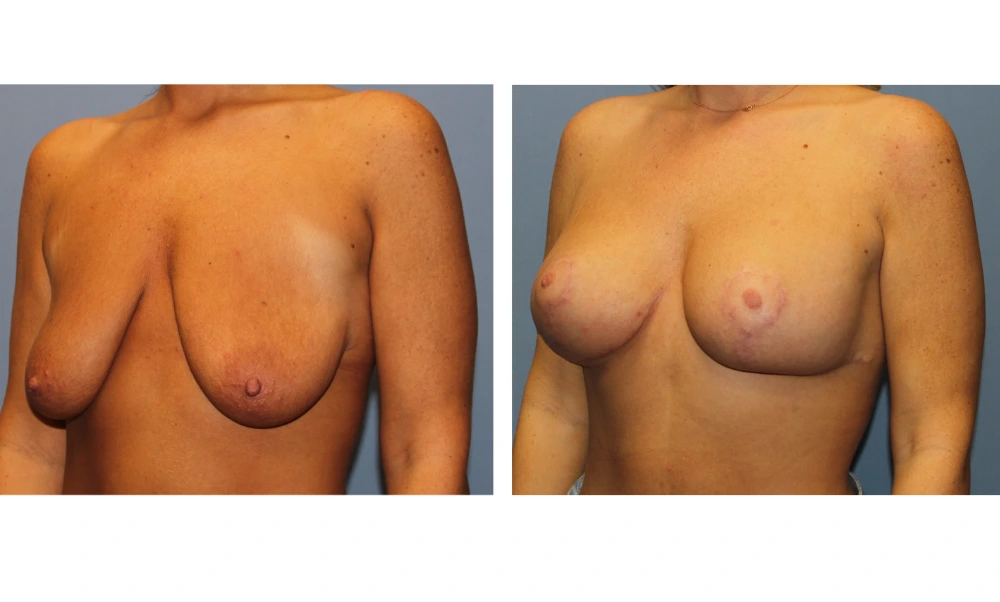 Breast Lift (Mastopexy) - Case 8 (3)