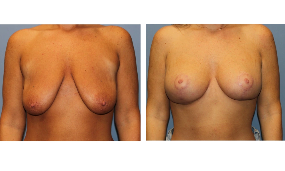 Breast Lift (Mastopexy) - Case 8