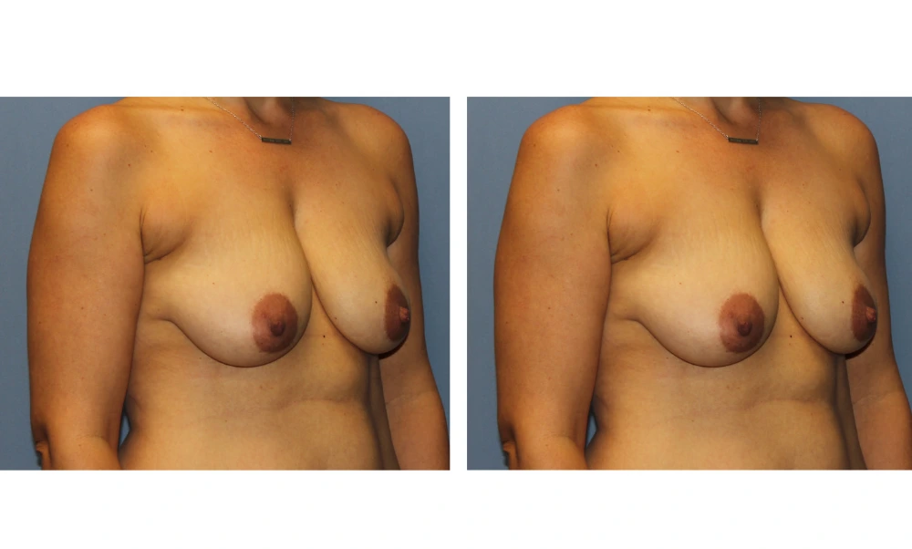 Breast Lift (Mastopexy) - Case 9 (1)