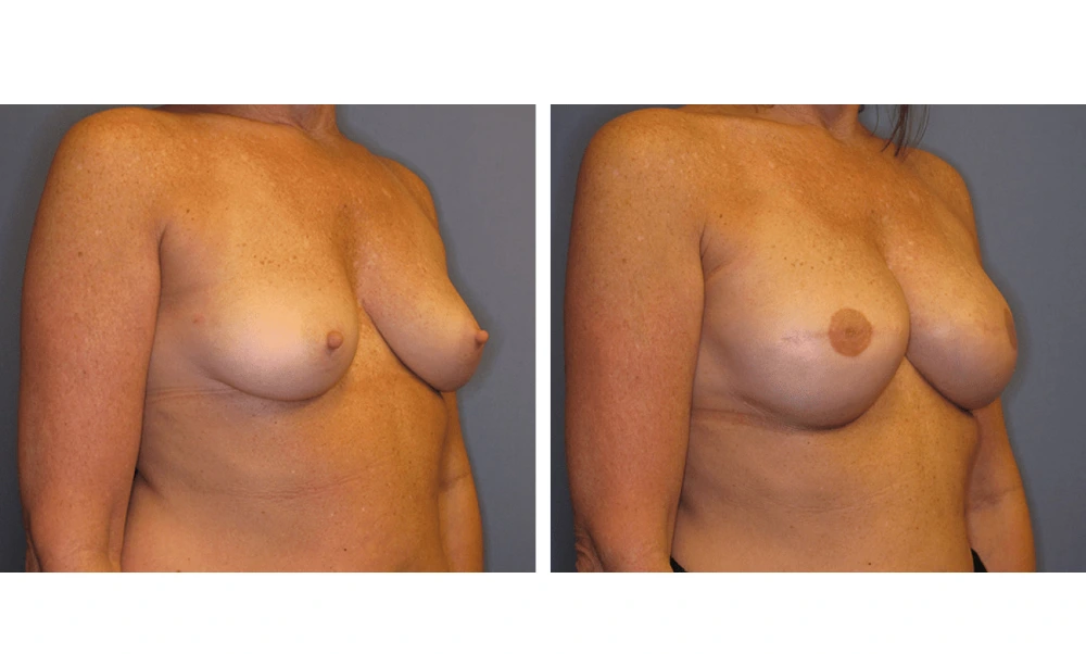 Breast Reconstruction - Case 2 (1)