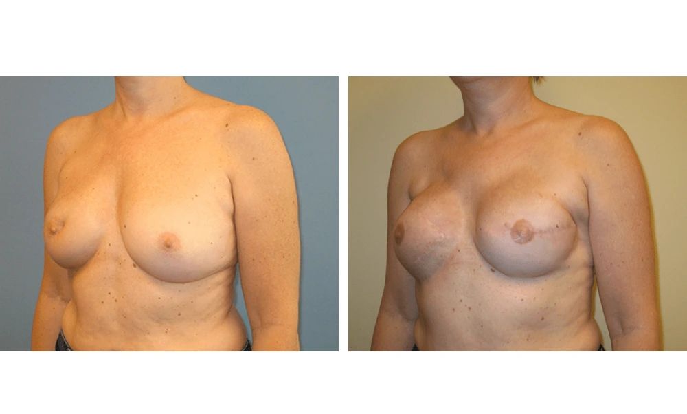 Breast Reconstruction - Case 3 (3)