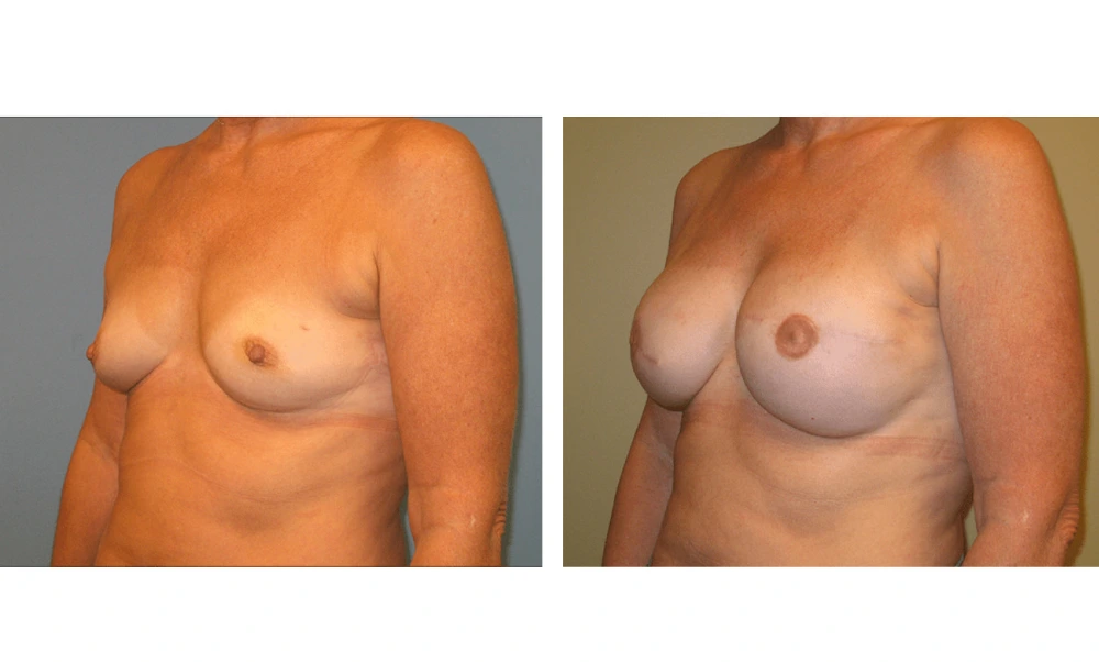 Breast Reconstruction - Case 5 (3)