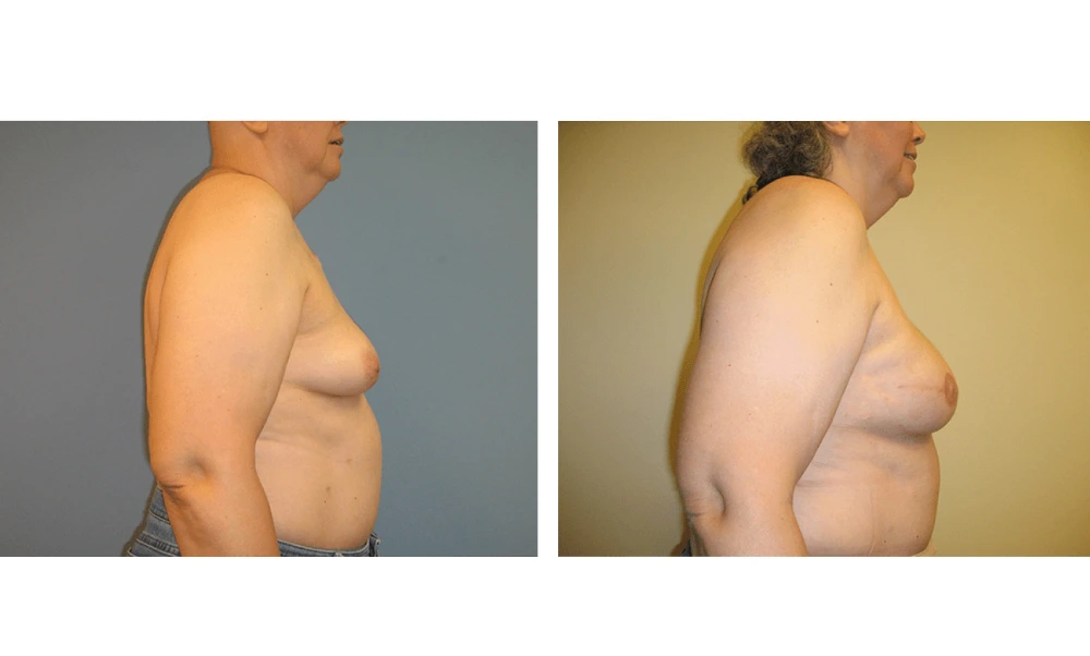 Breast Reconstruction - Case 8 (2)