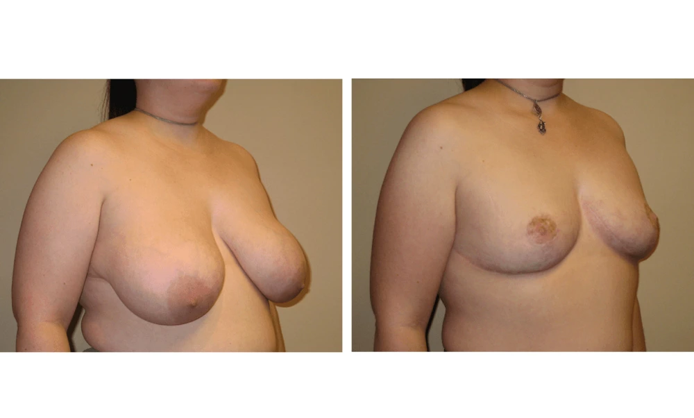 Breast Reduction - Case 2 (1)