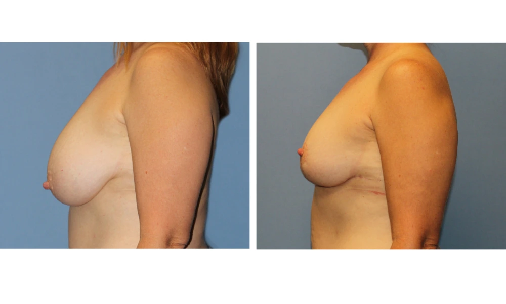 Breast Reduction - Case 4 (3)
