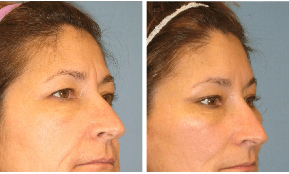 Brow Lift - Case 1 (1)