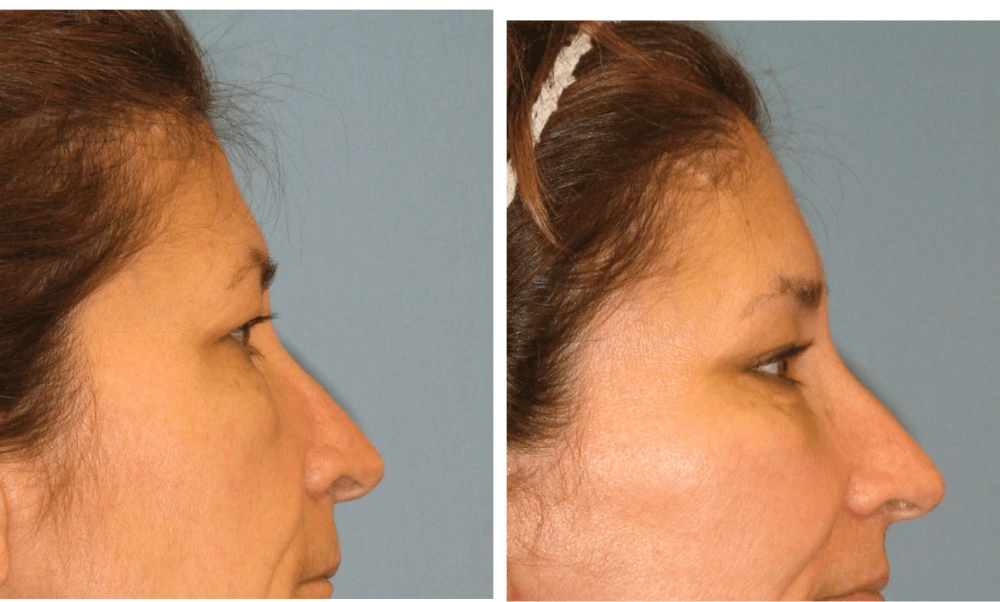 Brow Lift - Case 1 (3)