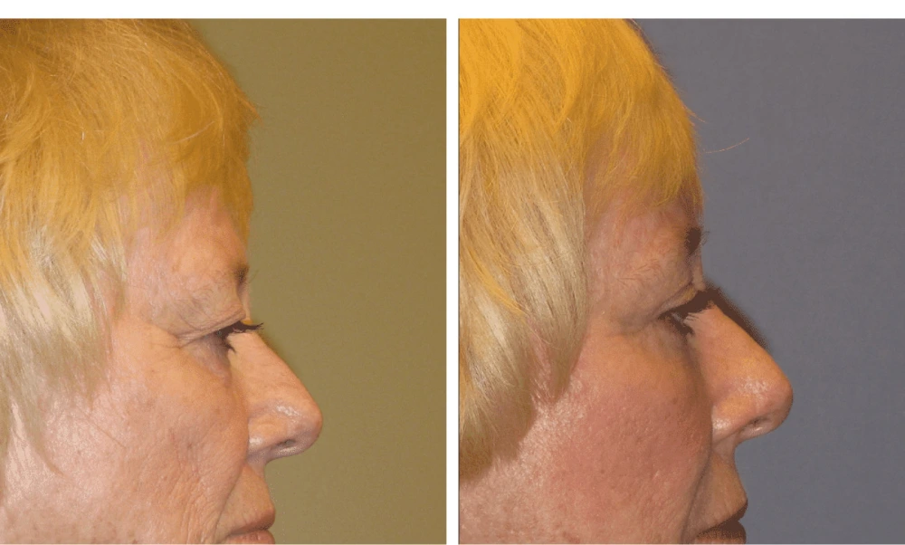 Brow Lift - Case 2 (1)