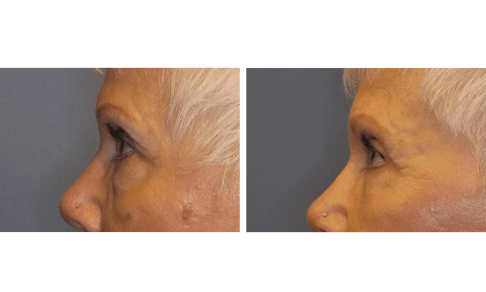Eyelid Surgery (Blepharoplasty) - Case 3 (3)