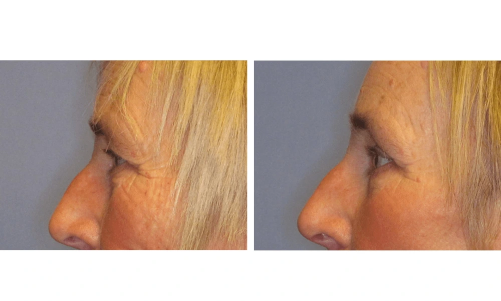 Eyelid Surgery (Blepharoplasty) - Case 5 (4)
