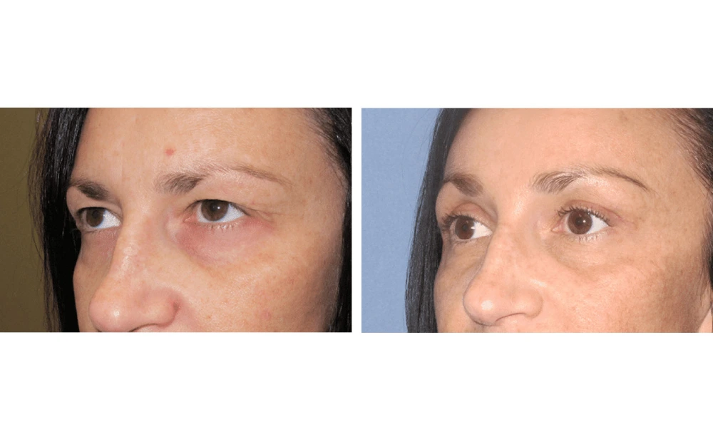 Eyelid Surgery (Blepharoplasty) - Case 7 (3)